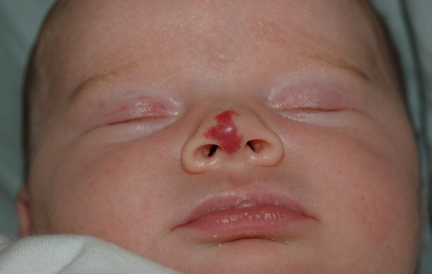 Лечение гемангиомы у новорожденных