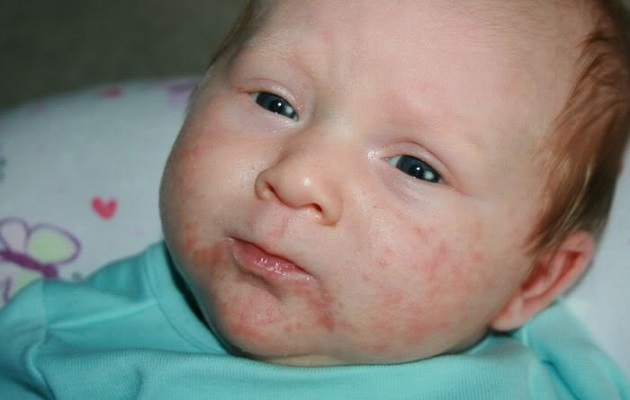 Атопический дерматит у новорожденного ребенка