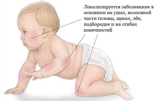 Атопический дерматит у грудного ребенка