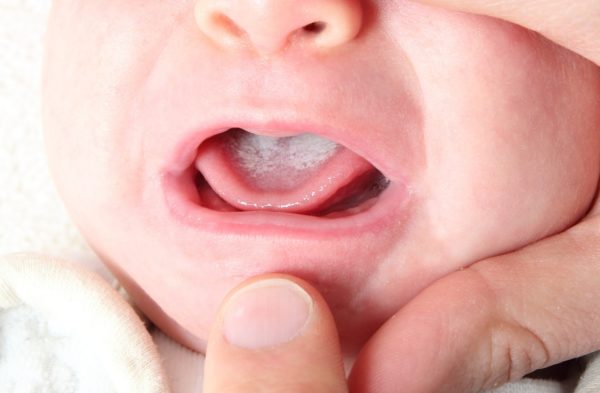 Чем лечить молочницу во рту у грудничка