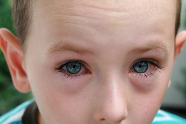 Аллергический конъюнктивит лечение у детей
