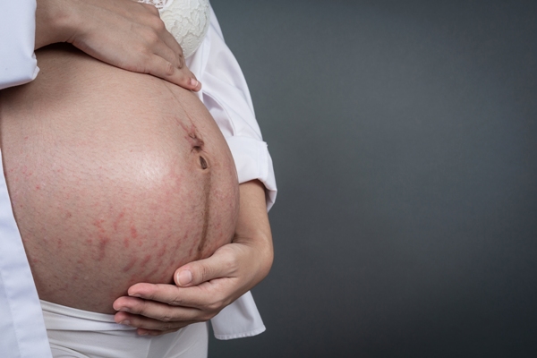 растяжки - распространенная проблема кожи во время беременности и после родов