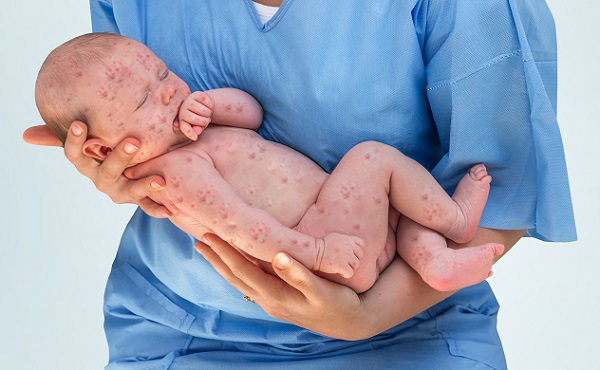 Акне новорожденных важно отличить от детской инфекции