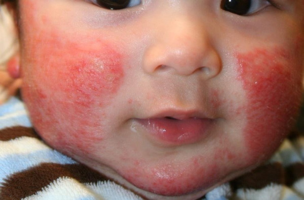 фото аллергических прыщиков у новорожденного
